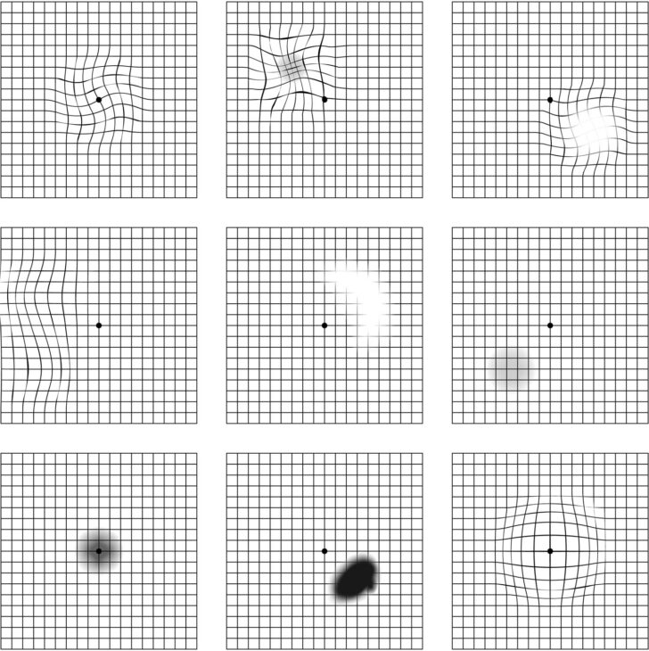 Macular Degeneration Chart Printable