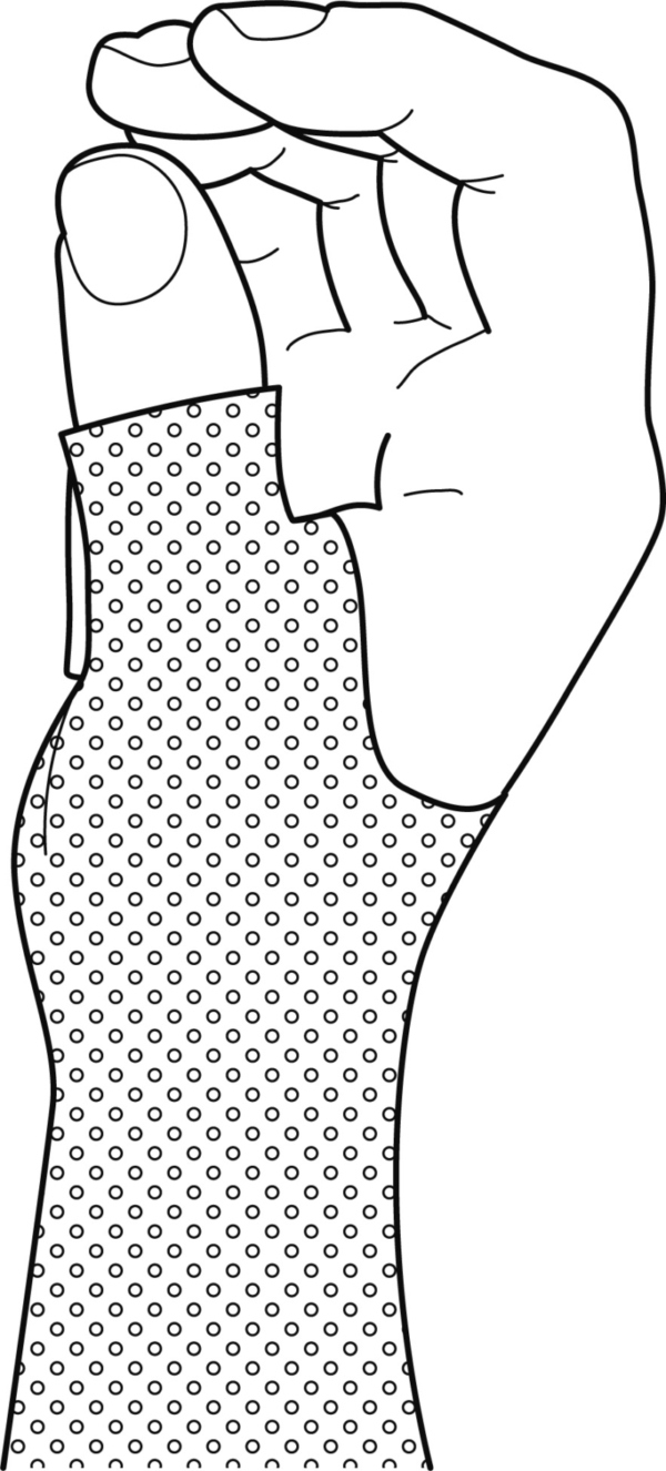 Guide Wrist And Thumb Immobilization Splint in Printable Thumb Spica Splint Pattern